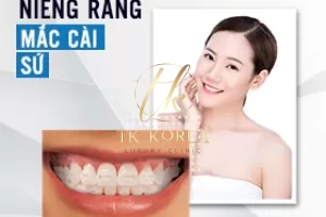 Niềng răng mắc cài sứ
