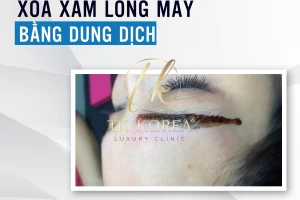 Xoá xăm bằng dung dịch