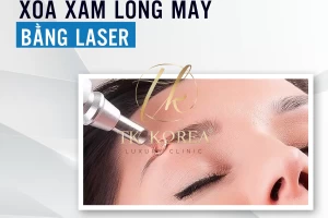Xoá xăm bằng Laser