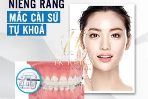 Niềng răng mắc cài sứ tự khoá