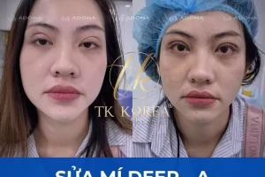 Sửa mí Deep-A