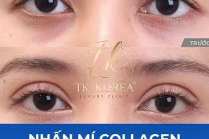 Nhấn Mí Chỉ Collagen - Bóc Mỡ