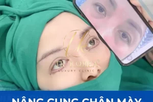 Nâng Cung Chân Mày Nội Soi