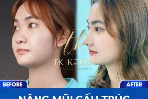 Nâng mũi cấu trúc