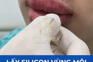 Lấy Silicon vùng môi