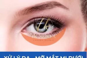Cắt Mí Dưới Xử Lý Da Thừa - Bọng Mỡ
