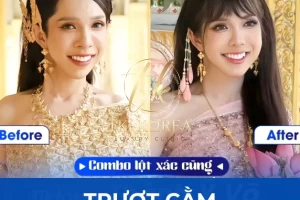 Trượt cằm