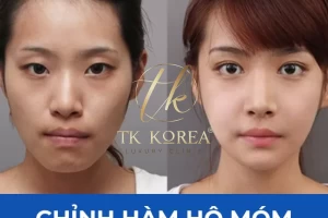 Chỉnh Hình Hàm Hô Móm