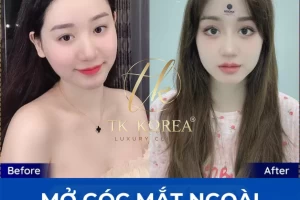 Mở góc mắt ngoài