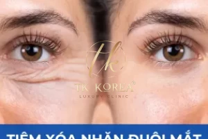 Tiêm xoá nhăn đuôi mắt